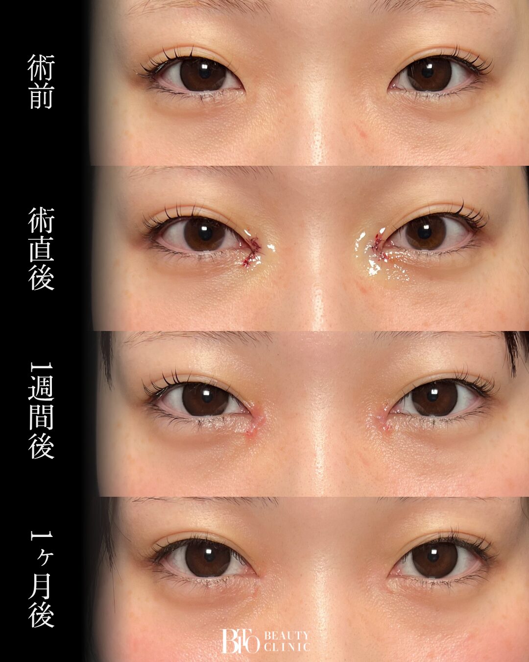 278.20代女性 目頭切開