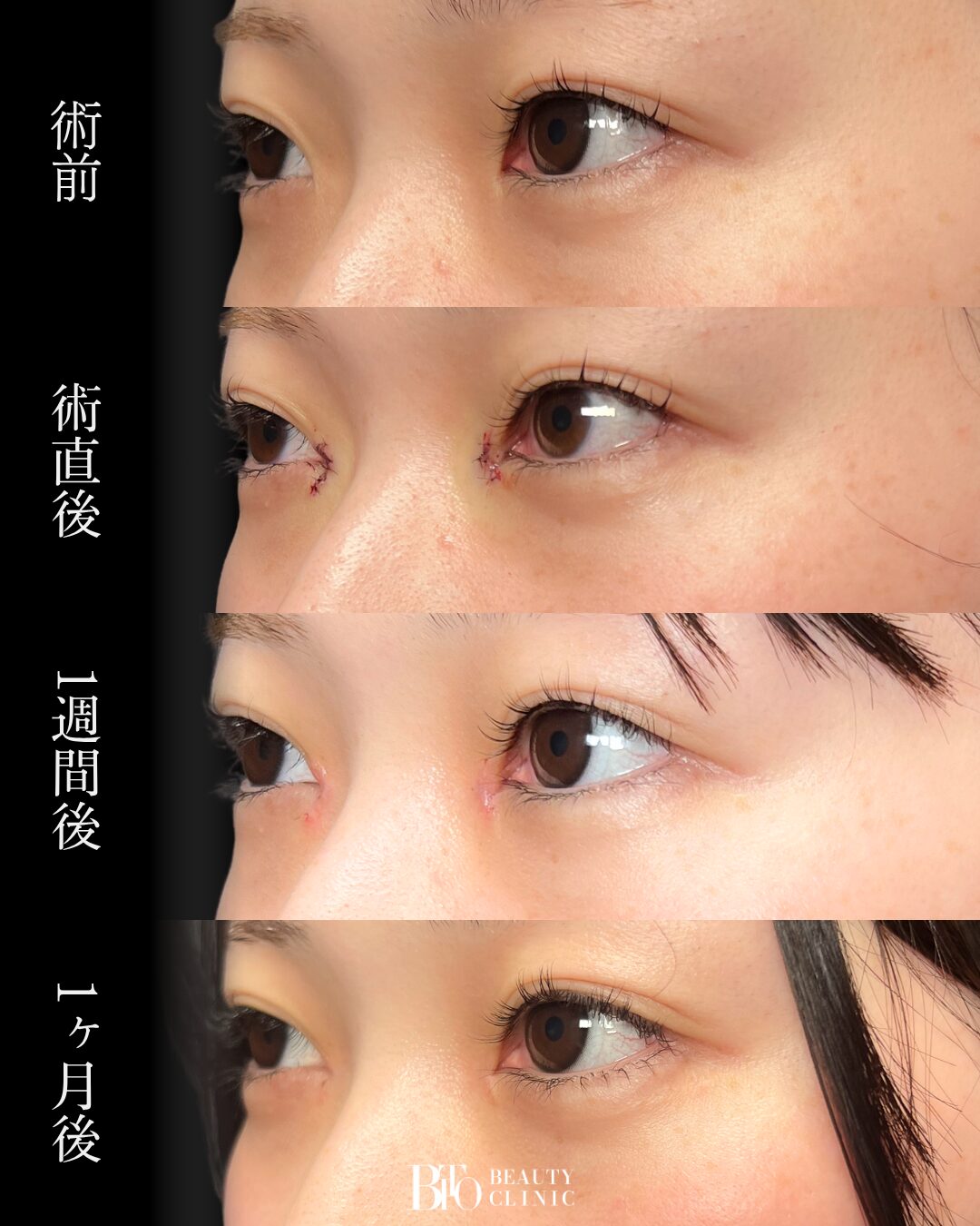 278.20代女性 目頭切開