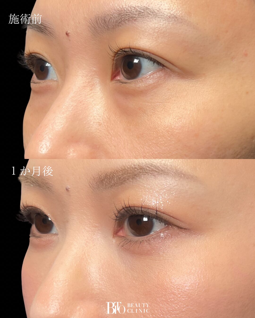 263.30代女性 切らないクマ取り(脱脂術)