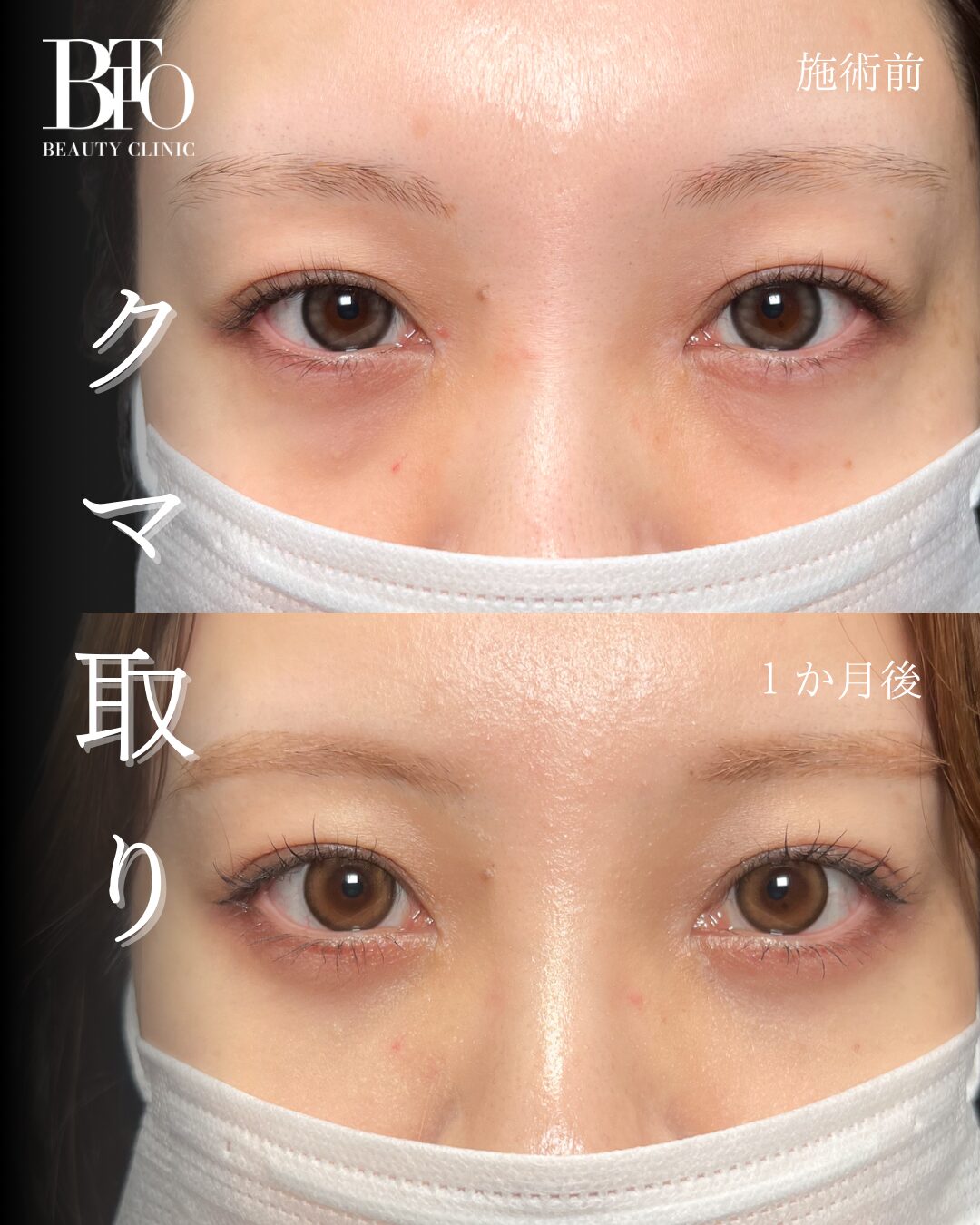 265.20代女性 切らないクマ取り(脱脂術)