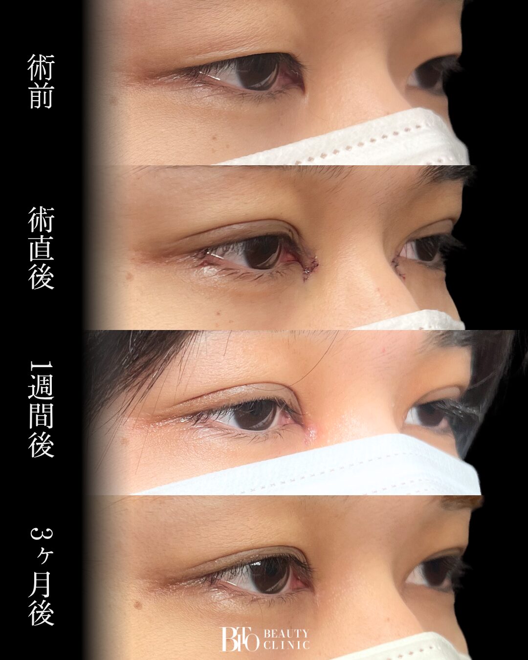 269. 20代男性 二重埋没・目頭切開