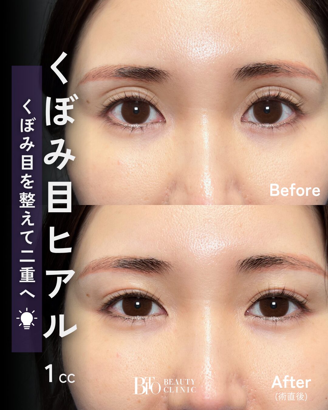 275.30代女性 くぼみ目のヒアルロン酸注入
