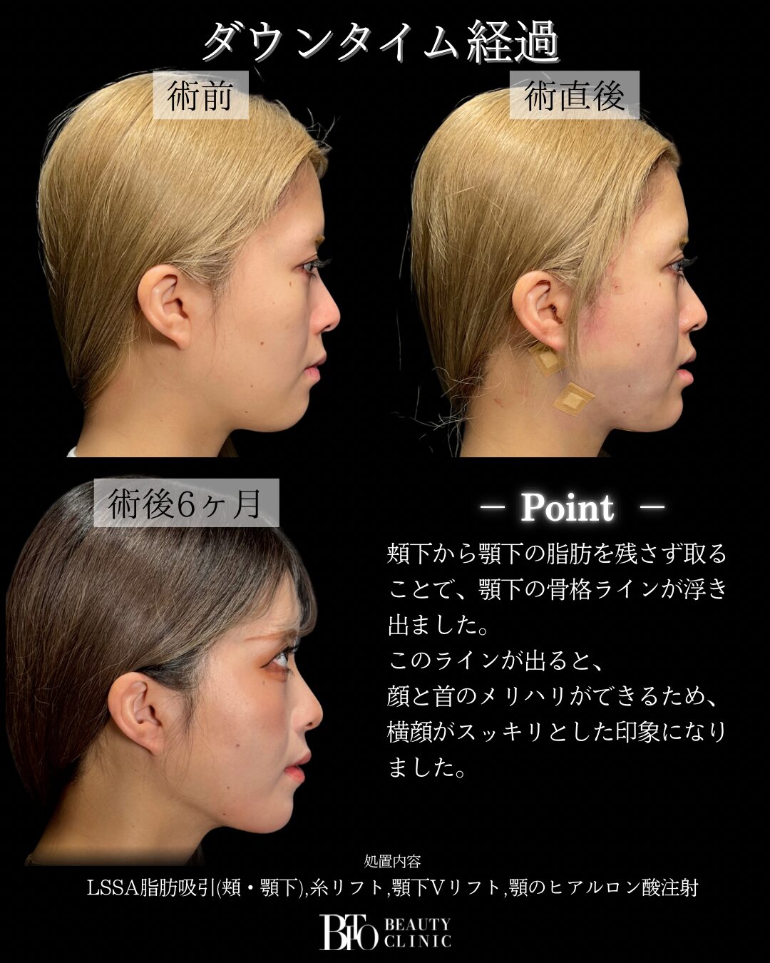 290.20代女性 顔のLSSA脂肪吸引