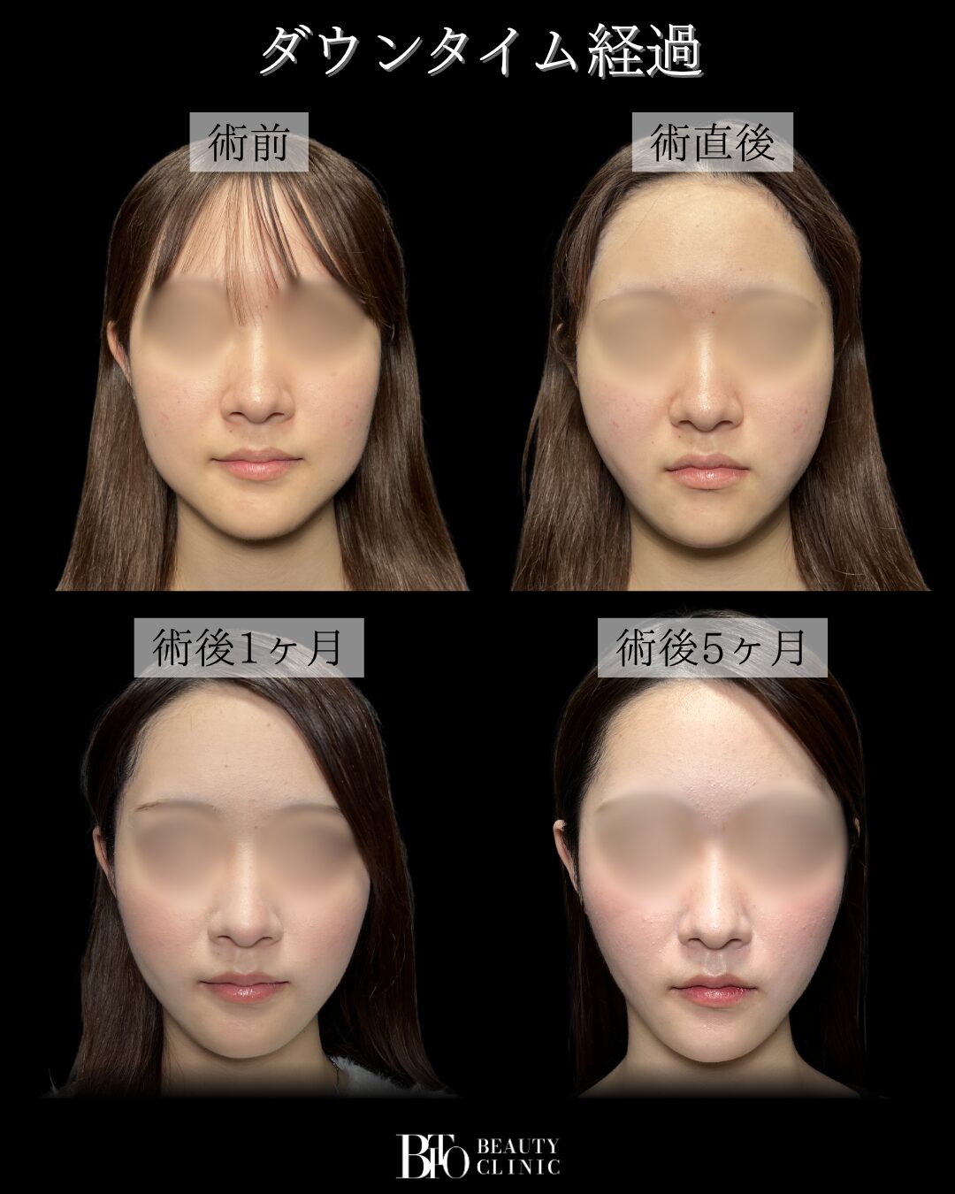 291.20代女性 顔のLSSA脂肪吸引