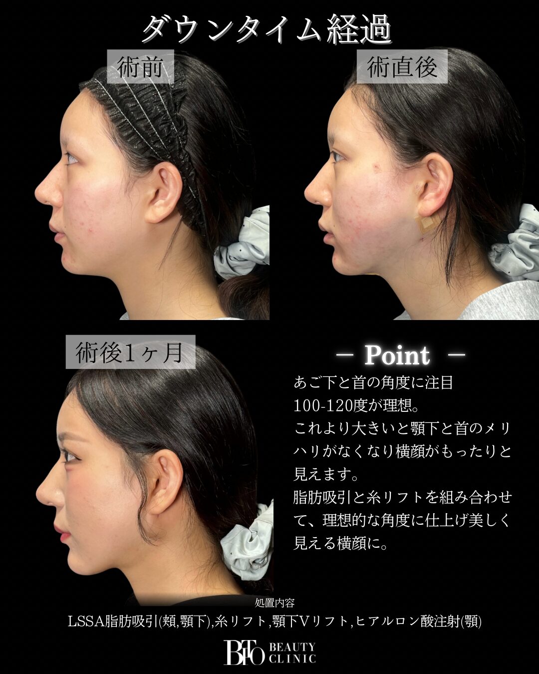 294.20代女性 顔のLSSA脂肪吸引