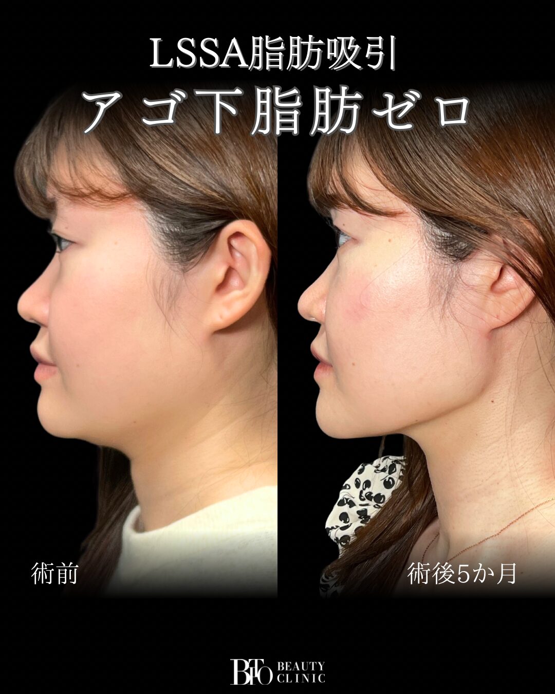 289.20代女性 顔のLSSA脂肪吸引