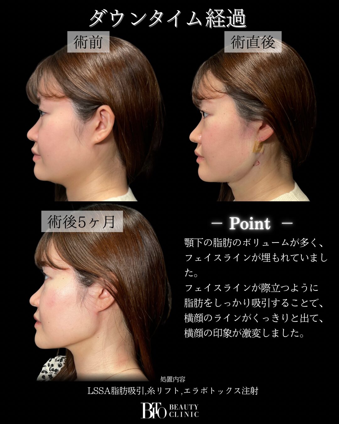 289.20代女性 顔のLSSA脂肪吸引