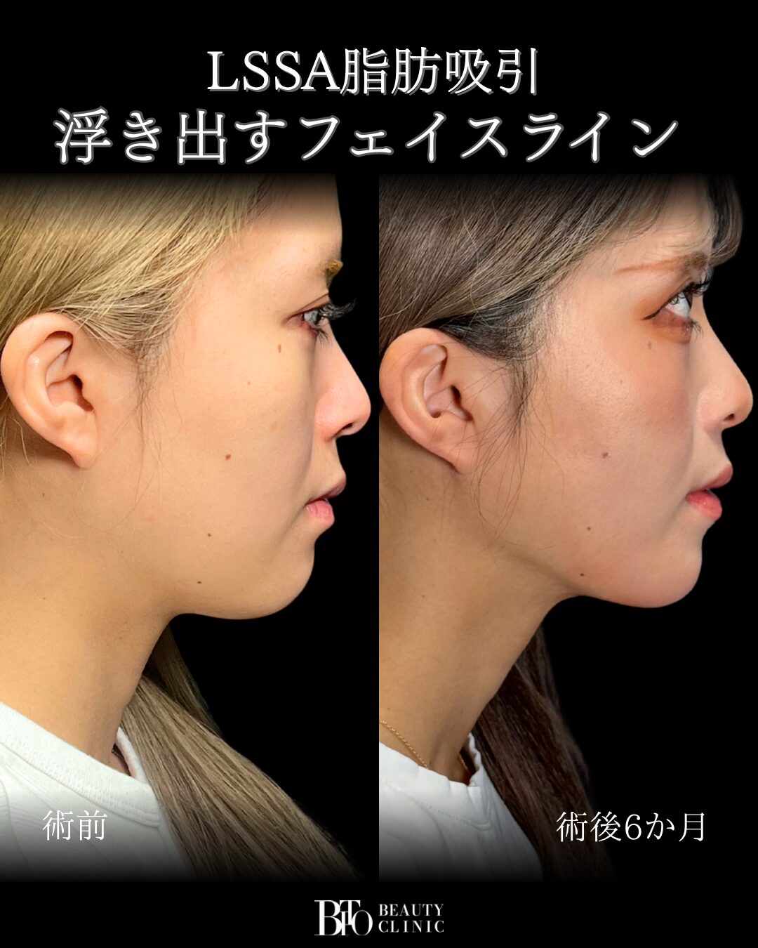 290.20代女性 顔のLSSA脂肪吸引