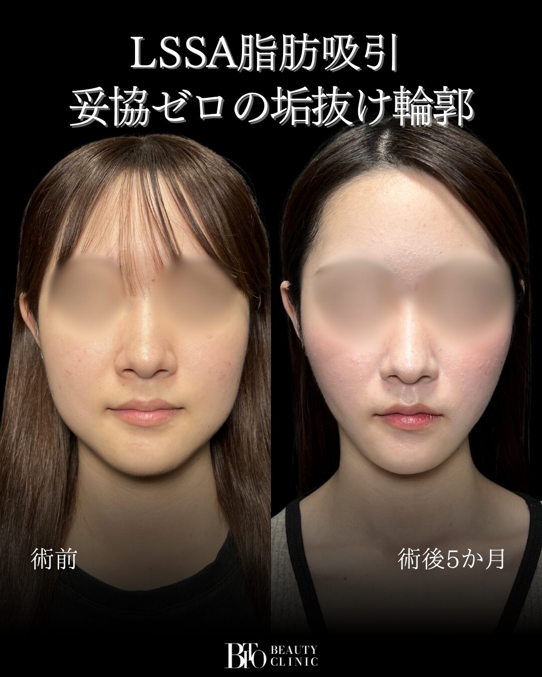 291.20代女性 顔のLSSA脂肪吸引