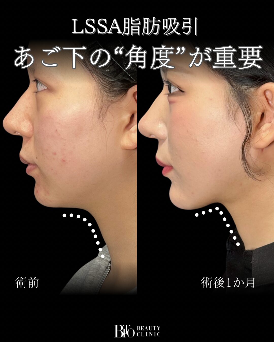 294.20代女性 顔のLSSA脂肪吸引